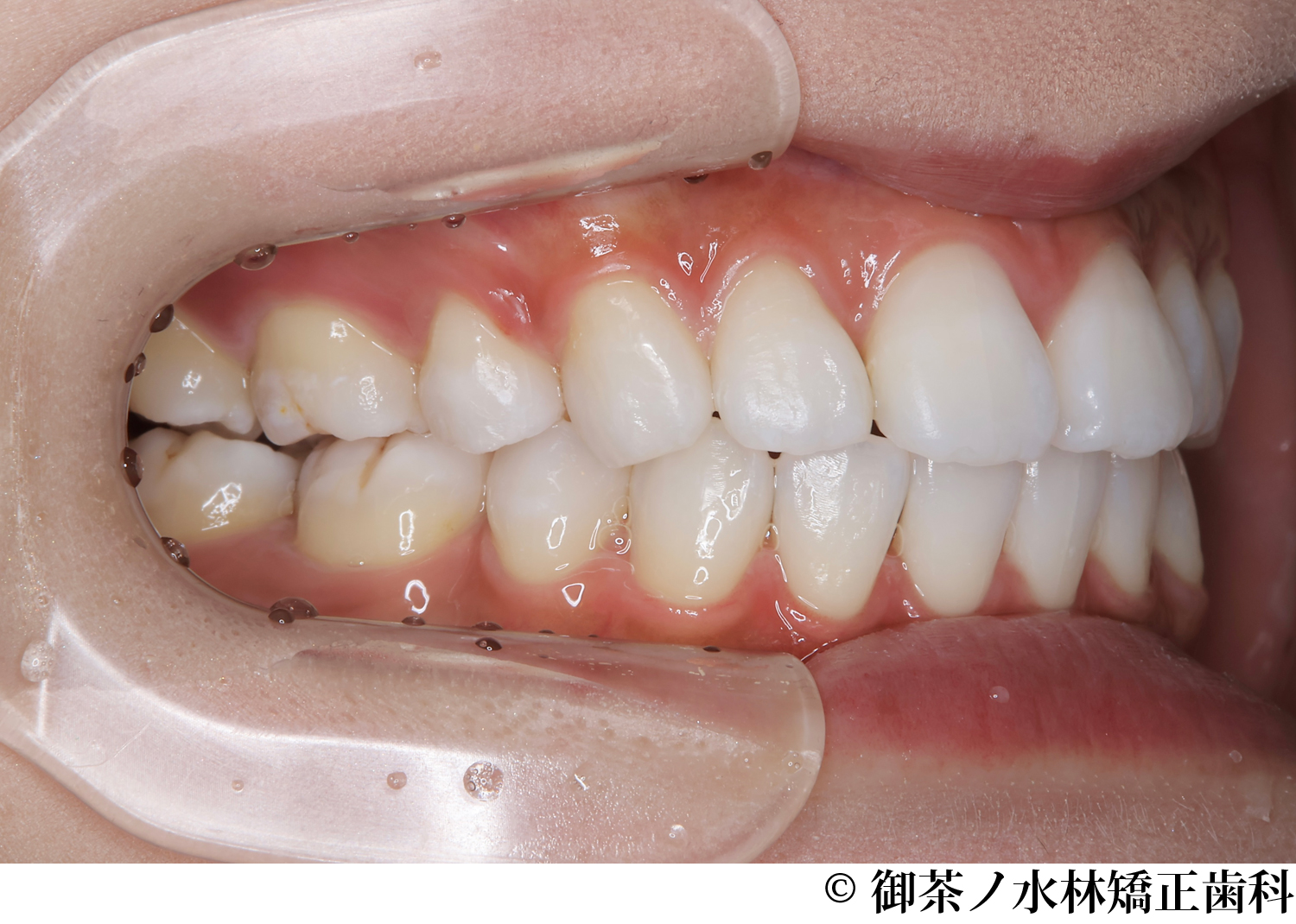 治療後