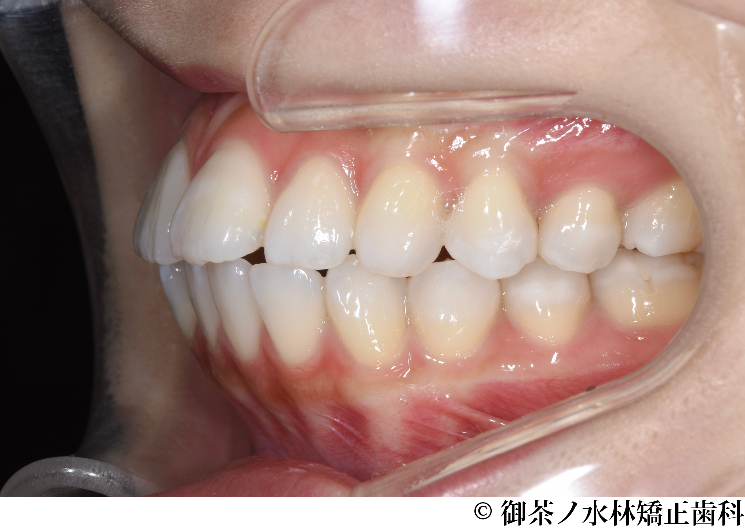 治療前