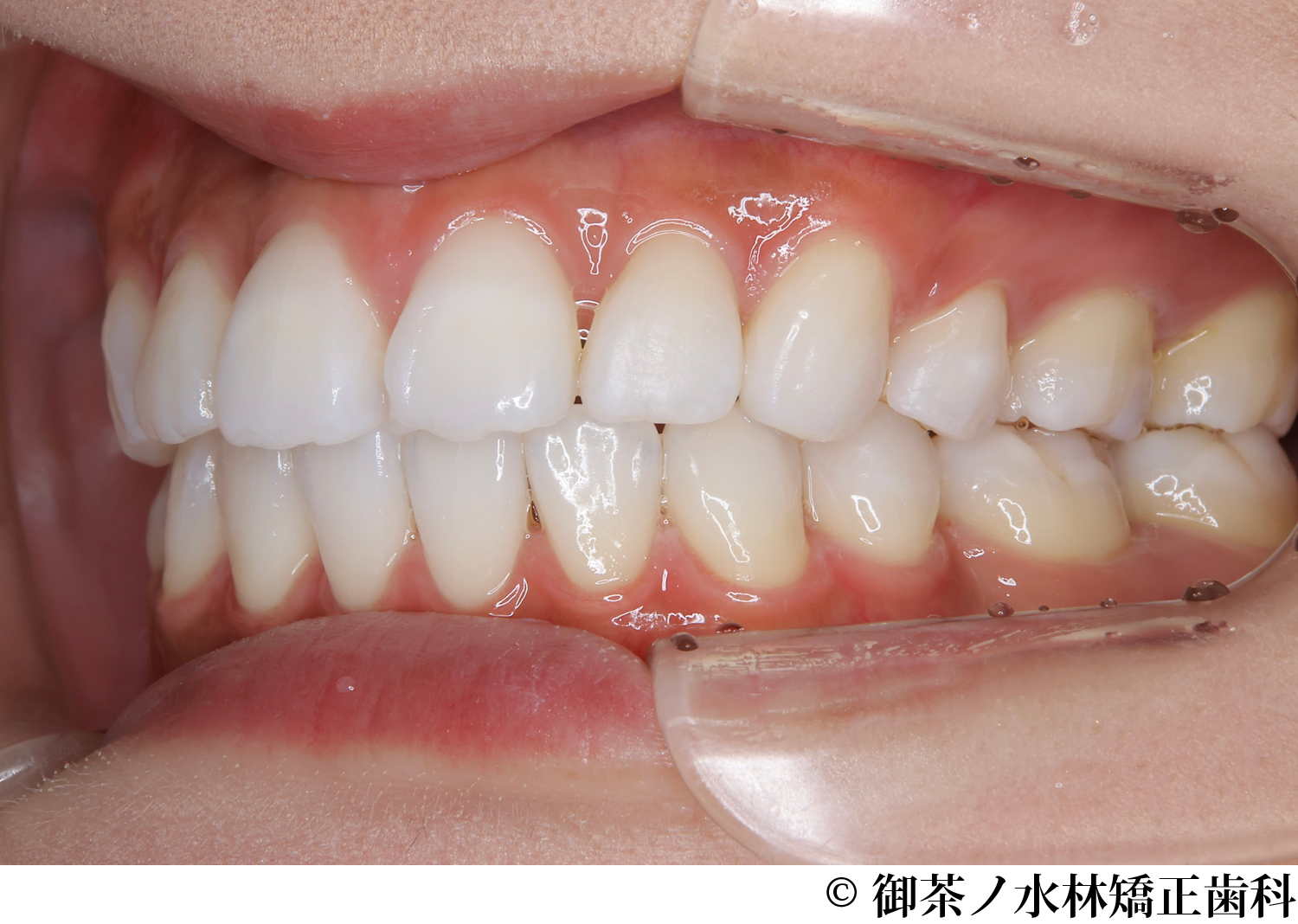 治療後