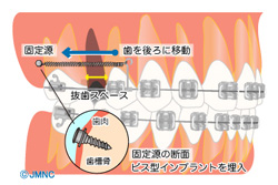 インプラントアンカー