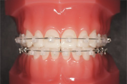 ¥»¥ë¥Õ¥é¥¤¥²¡¼¥·¥ç¥ó¼°¤Î¥Ö¥é¥±¥Ã¥ÈÁõÃÖ