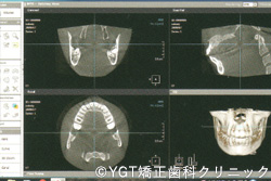 歯科用CT