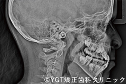 セファロ(頭部X線規格写真)