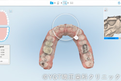 3D口腔内スキャナ