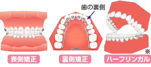 ワイヤー矯正