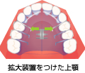 拡大装置をつけた上顎