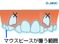 Check! 重度の八重歯の場合