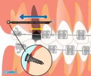 歯を効率的に動かすアンカースクリュー矯正の仕組み