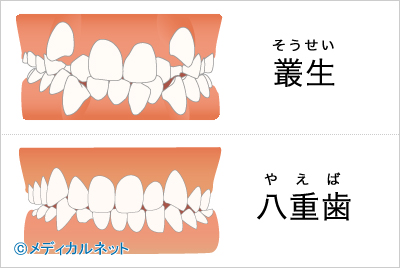 叢生[そうせい]、八重歯